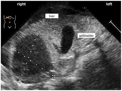 Case Report: Treatment of Extremely Preterm Infants With Birthweight Below 300 g: Case Series